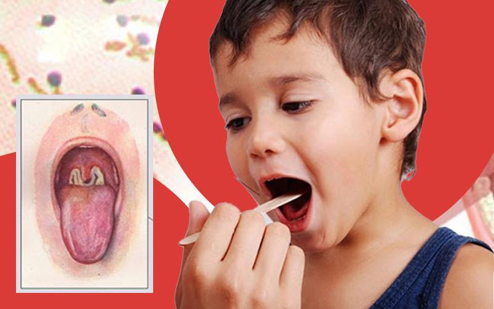 BỆNH BẠCH HẦU- NHỮNG ĐIỀU CẦN BIẾT